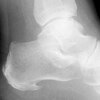 Learn How To Spot Posterior Calcaneal Spur