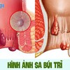 Sa búi trĩ là gì? Các phương pháp điều trị sa búi trĩ hiệu quả nhất hiện nay