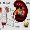 Obat Nyeri Karena Batu Ginjal