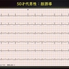 ECG-287：50才代男性。よくある不整脈です。