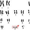 【新発見】ダウン症の染色体を除去できる新技術が発表！37.5%の成功率、今後の展望は？