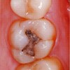 保存の臨床問題の解き方の基本