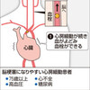 ダビガトラン