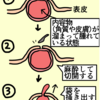 粉瘤に苦しめられた息子高3の夏