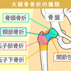 大腿骨の骨折