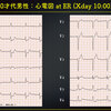 ECG-355：70才代男性。路上で倒れ、ショック状態でのER搬入。 = 心電図検定試験：傾向と対策 Q.003 =