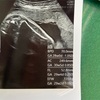 子宮筋腫合併妊婦☆妊婦健診２９週２日