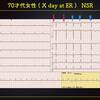 ECG-318：answer