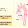 IABPの適応と禁忌