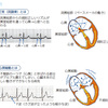 透析患者で一番多い不整脈。心房細動で脳梗塞を起こさせるな！