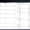 ECG-173:高カリウム血症の心電図--棚卸しです！