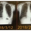 免疫治療薬オプジーボ投薬