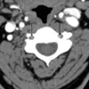 症例34：めまいと両側性難聴を発症した53歳男性（Clin Pract Cases Emerg Med. 2020 Nov;4(4):626-627.）