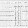 ECG-112：80才男性。偶然記録された心電図です。