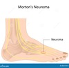 Combating Mortons Neuroma