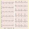 ECG-191：60才代男性。病棟の廊下で、バタンと倒れました。