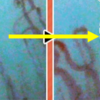 【毛細血管info②】血管のゴースト化が進むとどうなるのか