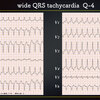 ECG-365：Wide QRS tachycardiaに慣れましょう！ その2= 心電図検定試験：傾向と対策 Q.012=