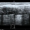 大腸癌の肝転移。転移性肝腫瘍のエコー像。