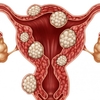 FIBROID TREATMENT