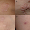 【まれな皮ふ疾患】〝環状肉芽腫 Granuloma annulare〟について