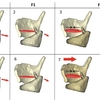 プロ歌手における声帯伸張の予測因子としての輪状甲状関節タイプ：CTJタイプは声帯伸張に影響を与える