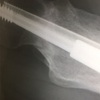 30代の大腿骨頸部骨折記録⑩〜停滞〜