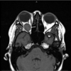 症例102：右眼後部痛と眼球突出により受診した妊娠28週妊婦（J Am Coll Emerg Physicians Open. 2020 Dec 31;2(1):e12340.）