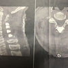 頚髄損傷で...十年前に手術を...しました...