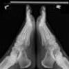 The Right Way To Treat Calcaneal Spur