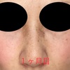 シミ治療　レーザー照射後【１ヶ月目】