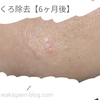 【レーザーでほくろ除去】半年後までの経過ブログ