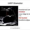 心エコー：LVOT径の測り方
