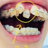 歯列矯正10カ月　上下ブラケット5ヶ月