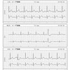 心電図に混入するノイズの話　その3 （f波に見えるアーチファクト）