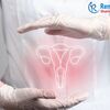 Cervical Cancer Screening Market, Size, Share, Growth and Key Players ⅼ Forecast (2023 - 2028) ⅼ Renub Research