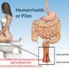 Cara Mengobati Benjolan Ambeien Stadium 3 Tanpa Operasi