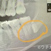 顎骨嚢胞の手術と入院②〜検査から入院