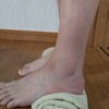 捻挫から腓骨筋腱炎と痛み過敏症(CRPS)  リハビリ3回目 ⑤