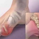 gout【痛風】は生涯の友…