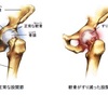 股関節痛