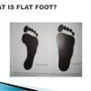 What Are The Key Causes Of Adult Aquired Flat Foot ?