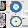 正常圧水頭症の予後を考える