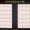 ECG-265：60才代女性。急な胸部不快です。