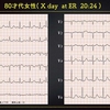ECG293：80才代女性。嘔吐とめまいでした。心電図が経時的に動きます。