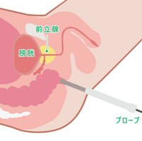 経直腸的超音波検査