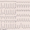 ECG-212：80才代男性。動悸と胸部絞扼感でER受診です。