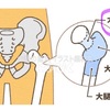 左大腿骨頸部骨折した私の話…①