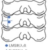 椎孔周囲スクリュー(paravertebral foramen screw: PVFS)