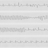 ECG-152：answer